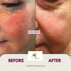 Revitalize Your Skin with The Yvette Clinic's Cutting-Edge IPL Treatment