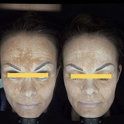Why Pigmentation Is One of the Hardest Skin Conditions to Treat