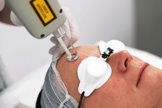 ReSURFACE LYNTON Ablative laser - Dynamix Machine