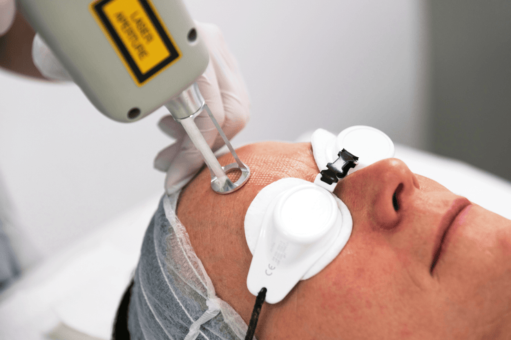 ReSURFACE LYNTON Ablative laser - Dynamix Machine