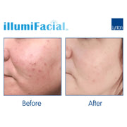 IPL Illumifacial, Pigment & Rosacea Removal