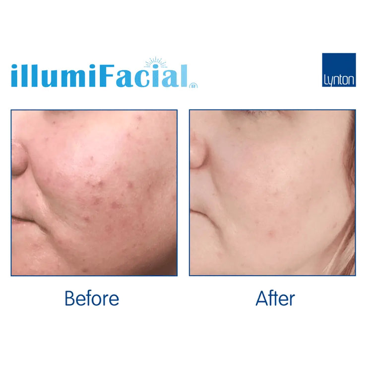 IPL Illumifacial, Pigment & Rosacea Removal